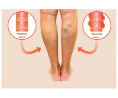 Alternative Treatment for Varicose Veins