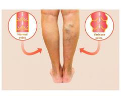 Alternative Treatment for Varicose Veins